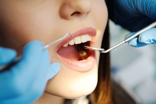 Why You Should Have Amalgam Fillings Removed