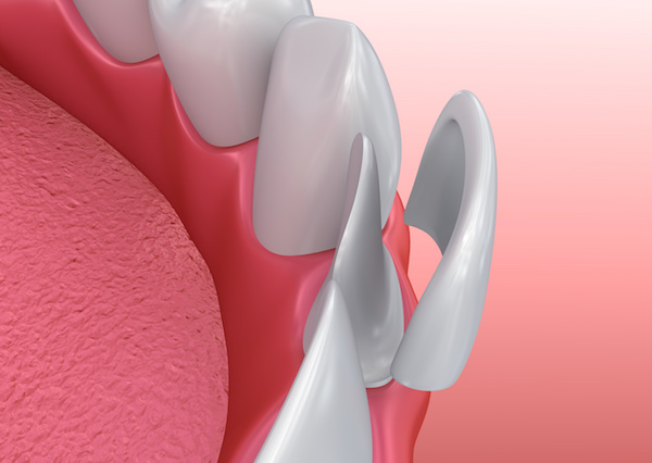 Am I a Candidate for Veneers
