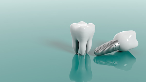 When Do I Need Dental Implants?