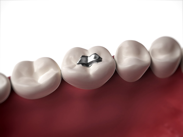 Understanding Safe Amalgam Removal