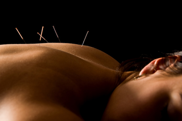 Acupuncture for Dental Anxiety