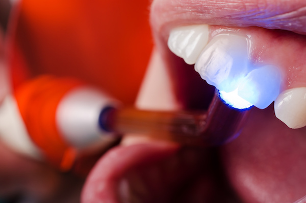 Why We Prefer Tooth-Colored Fillings