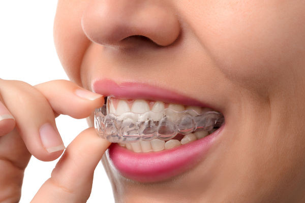 The Pros of Invisalign