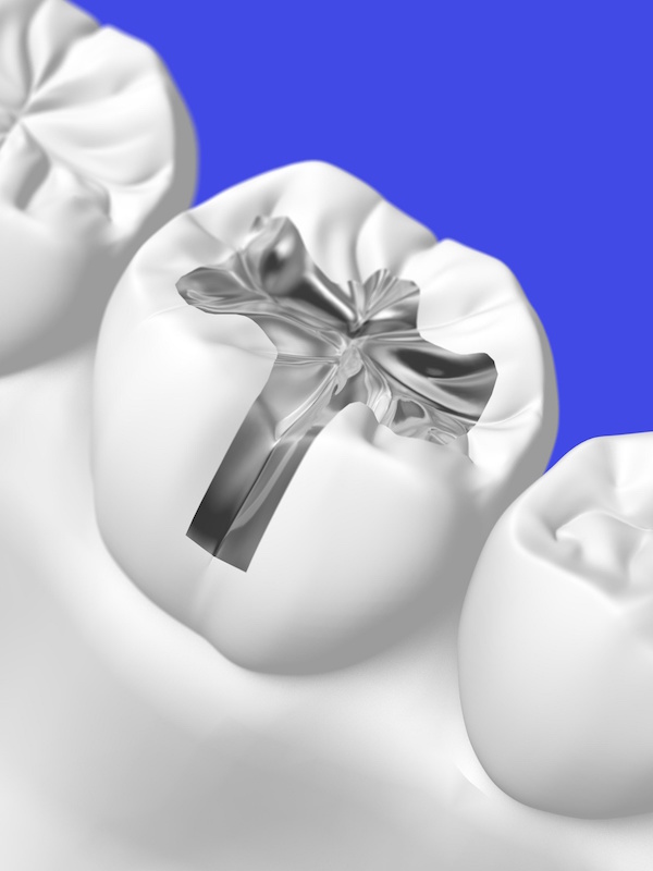 Replace old fillings