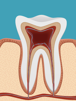 Link between periodontitis and atherosclerosis