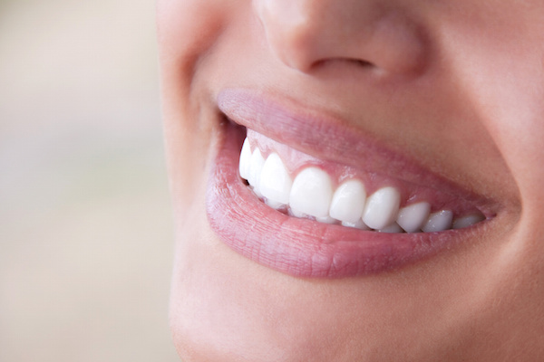 Crowns or Veneers?