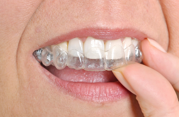 Invisalign available at Smiles by Shields!