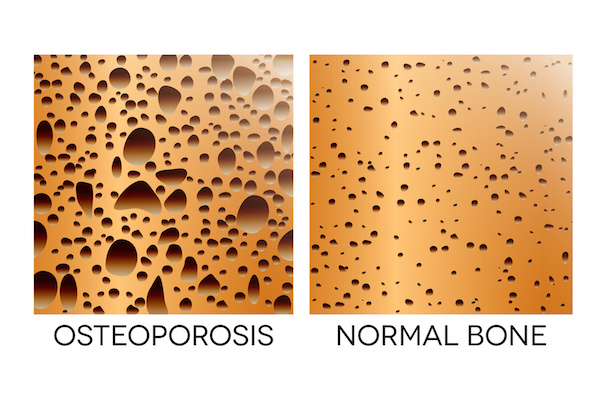Bone-loss, gum disease, and postmenopausal women
