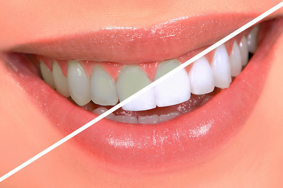 Tips on Tooth Whitening