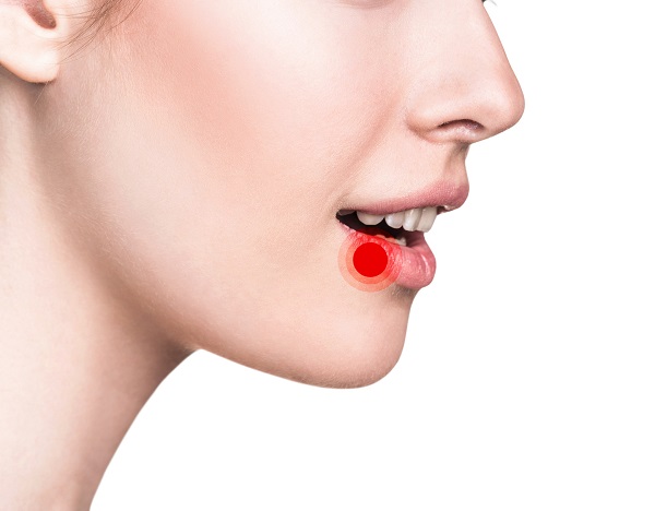 Understanding Canker Sores and Treating Them – Oral Health