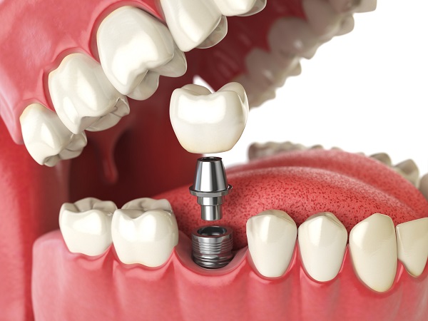 dental implants deconstructed