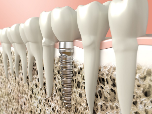 Dental Implants Promote Dental Wellness