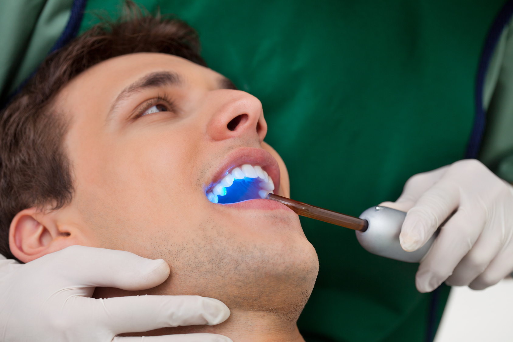 Sealants for Cavity Prevention