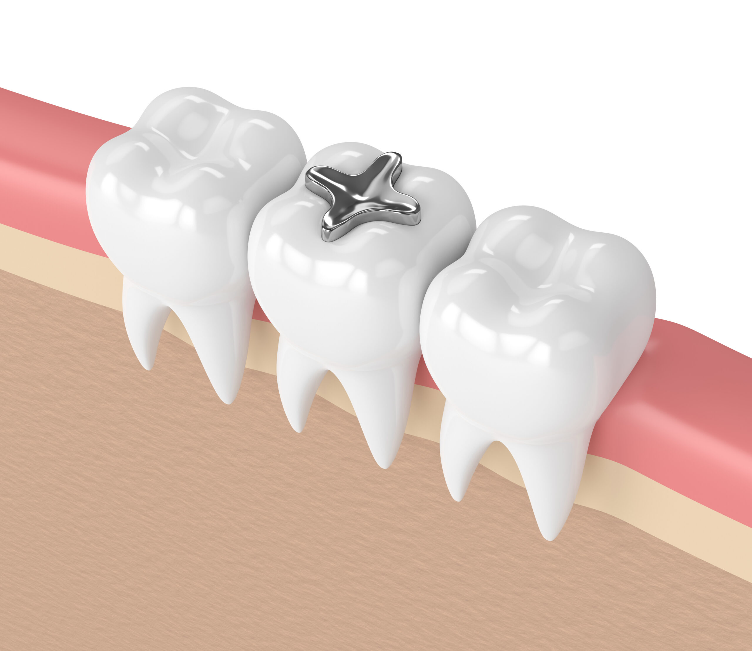 How Can Mercury Fillings Damage Your Body and The Environment