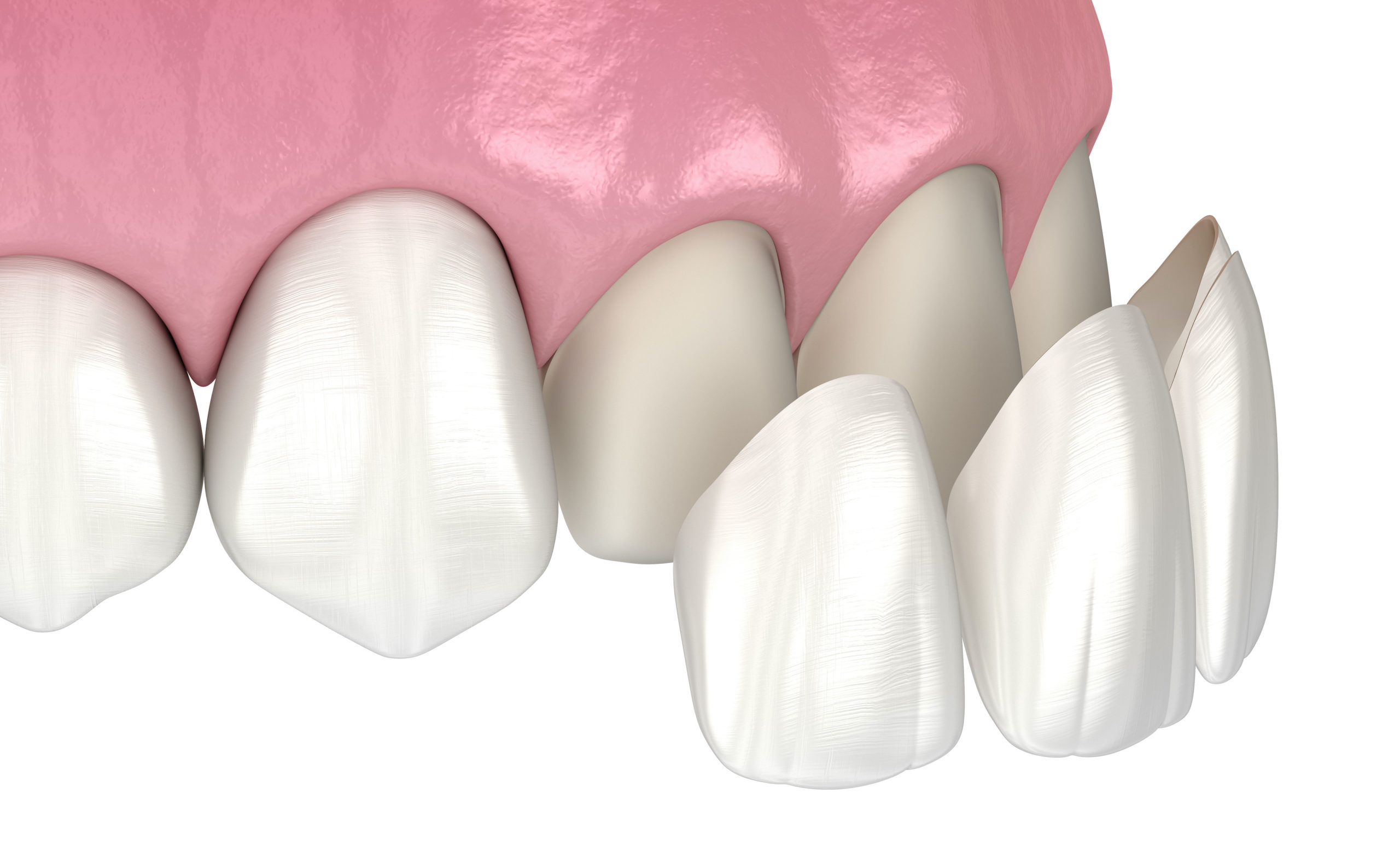 What Makes A Good Candidate For Veneers?