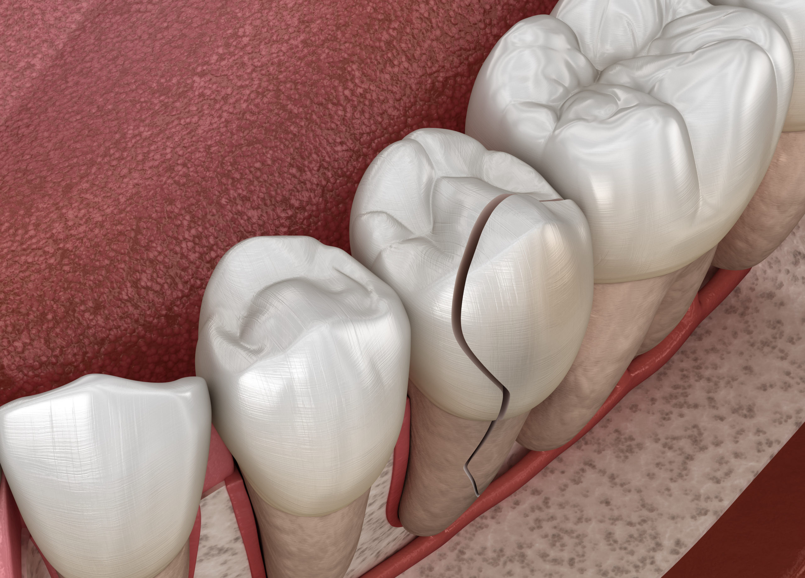 How To Care for A Cracked Tooth