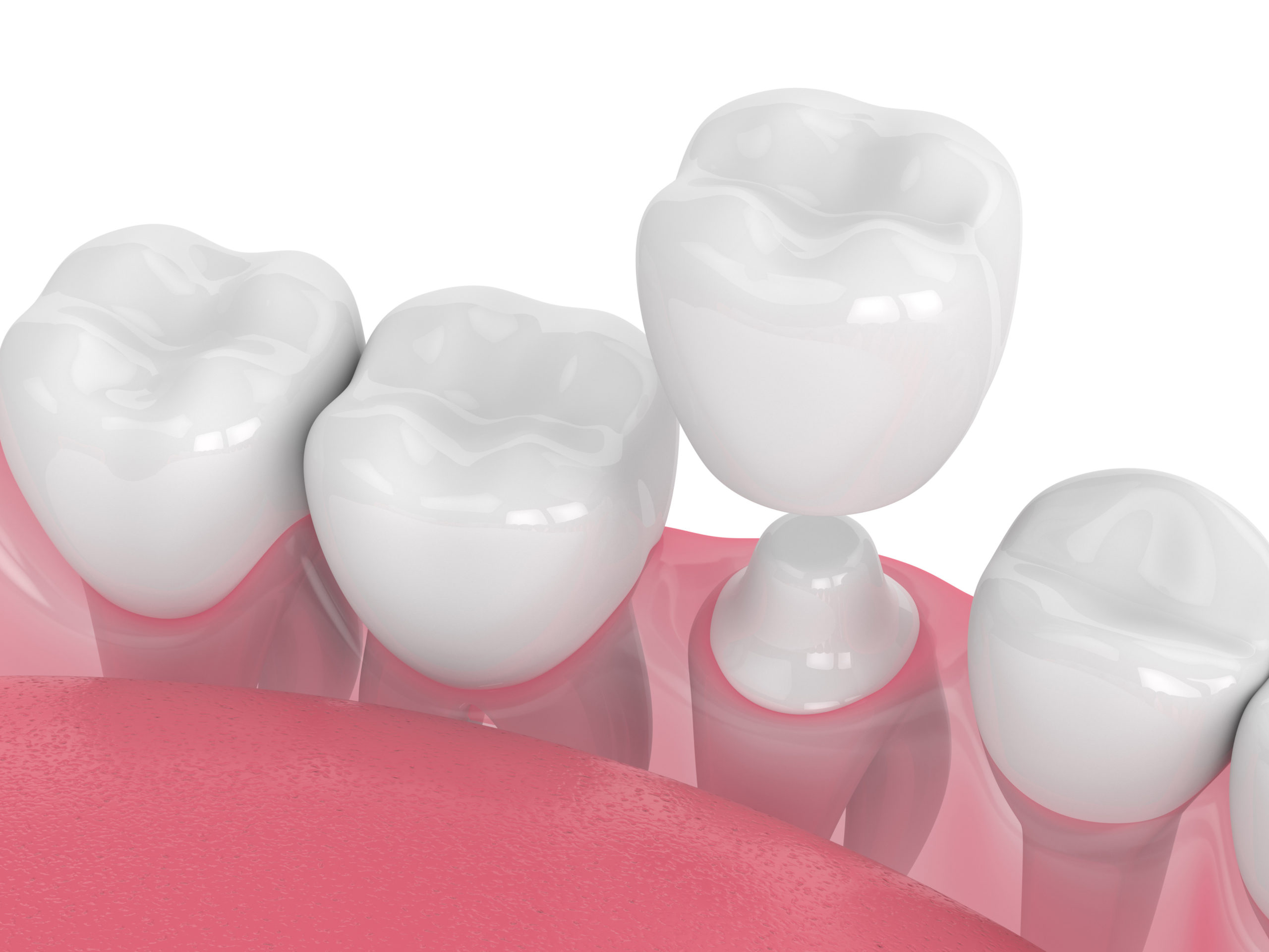 The Art of Crown and Bridge Maintenance and Care: Tips for Prolonging their Lifespan
