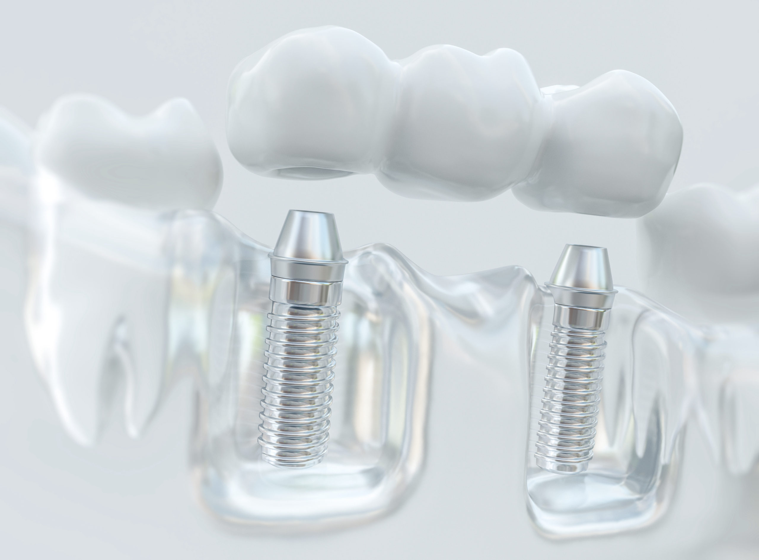 Bridge Your Teeth Gap: All about Dental Bridges