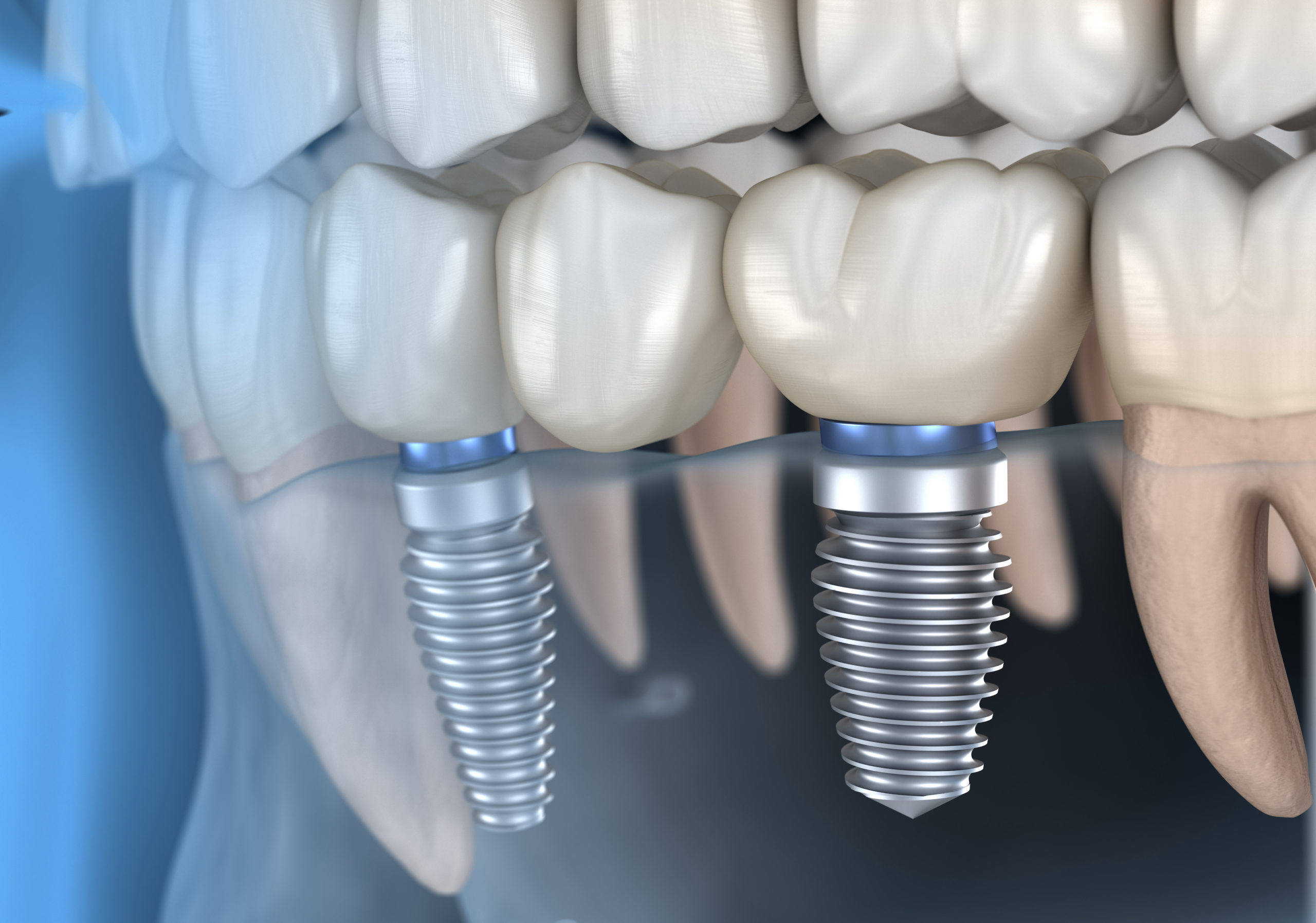 When Do You Need a Filling vs. a Crown? Understanding the Difference 