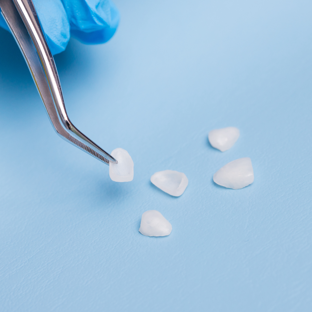 How Long Do Veneers Last On Your Teeth?