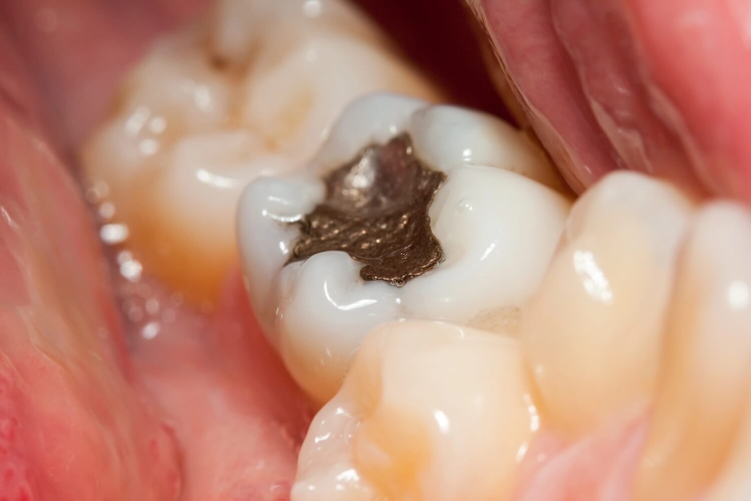 The Dark Side of Silver Fillings: How Mercury Could Affect Your Health