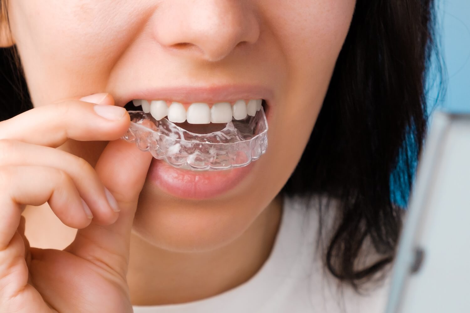 Beyond Appearance: How Clear Braces Improve More Than Just Your Smile